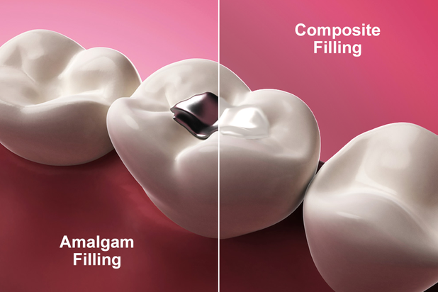 advantages of dental amalgam
