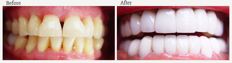 prisma-dental-before-after-case-4