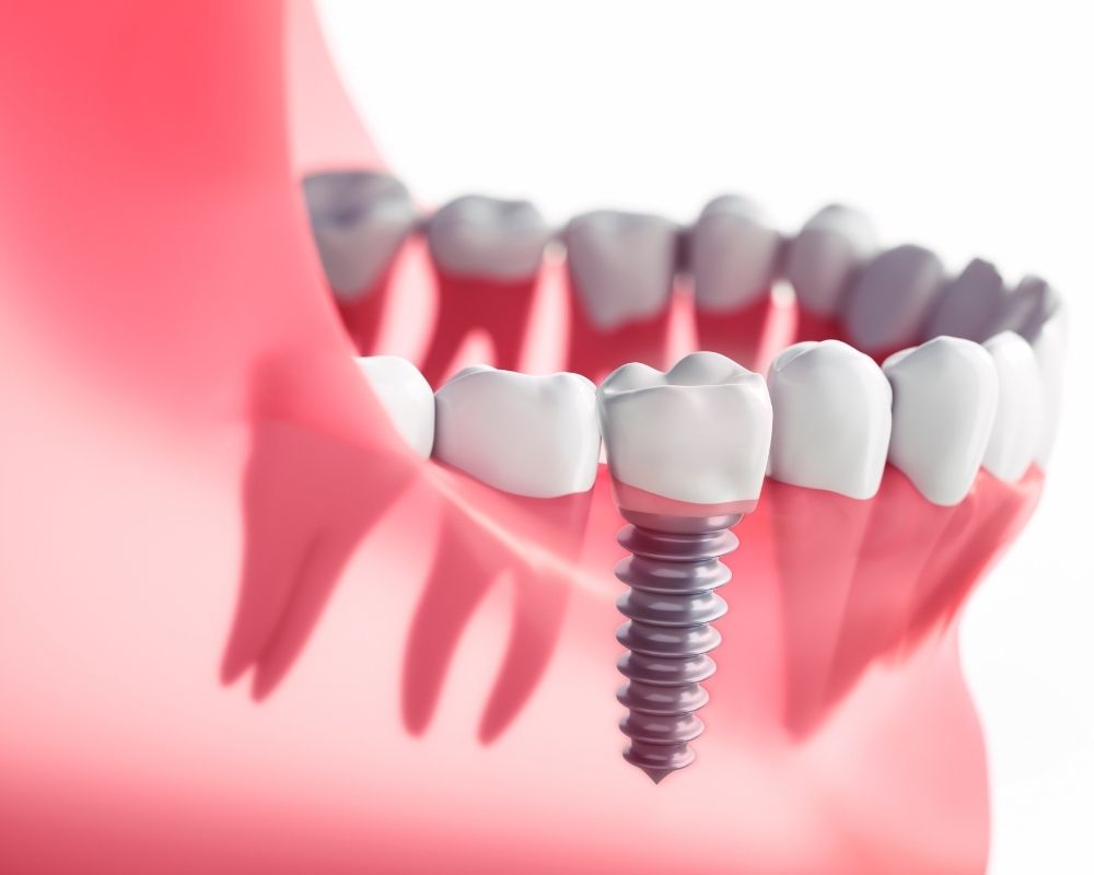 Dentures vs. Implants vs. Bridges