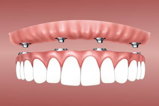 Dentures vs. Implants vs. Bridges