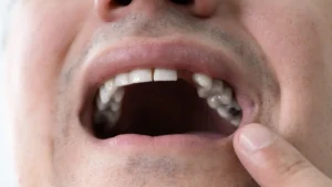 Dental Avulsion